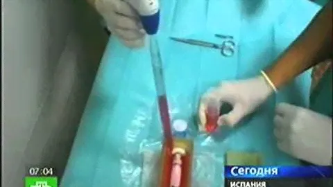 Операция по пересадке искусственной трахеи